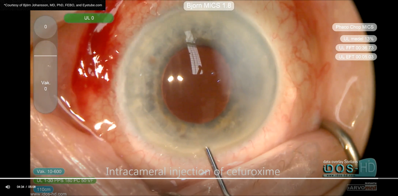 Suprachoroidal Hemorrhage