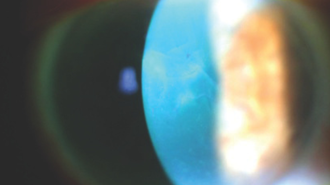 High Myopia After Cataract Surgery
