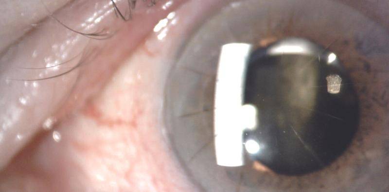 Worsening Vision From a Dislocated IOL