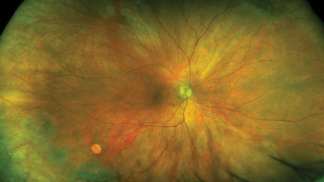 Use of UWF Retinal Imaging in Cataract Surgery