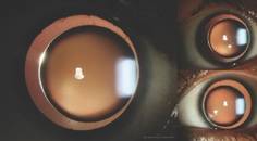 Bilateral Microspherophakia With High Myopia