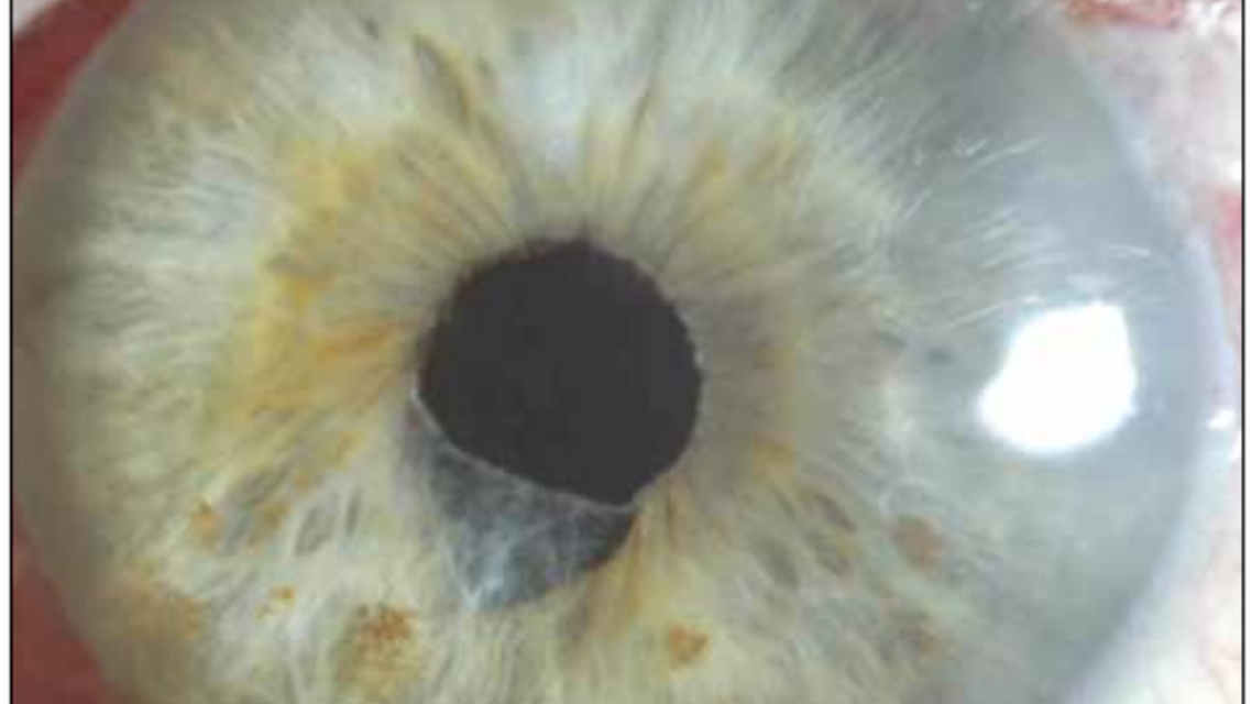 Complications of Small Pupil Cataract Surgery