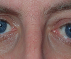 Managing Thyroid Eye Disease