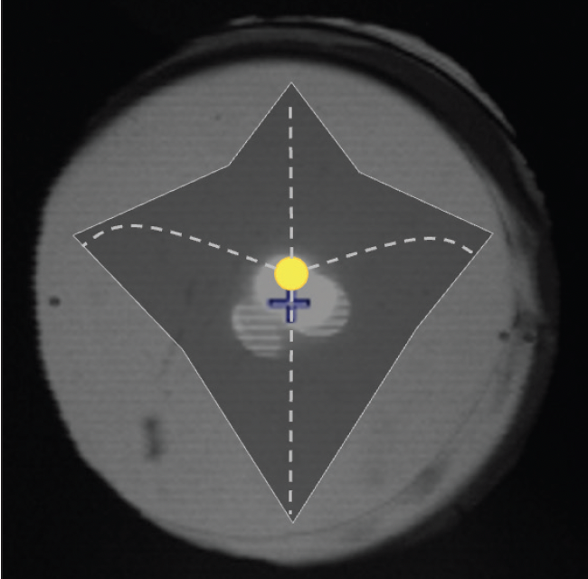 Overcoming the Last Barrier to Good Visual Outcomes
