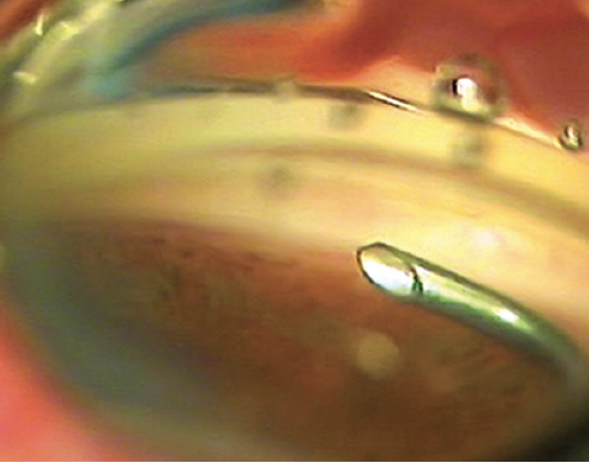 Early Experience With the OMNI Surgical System
