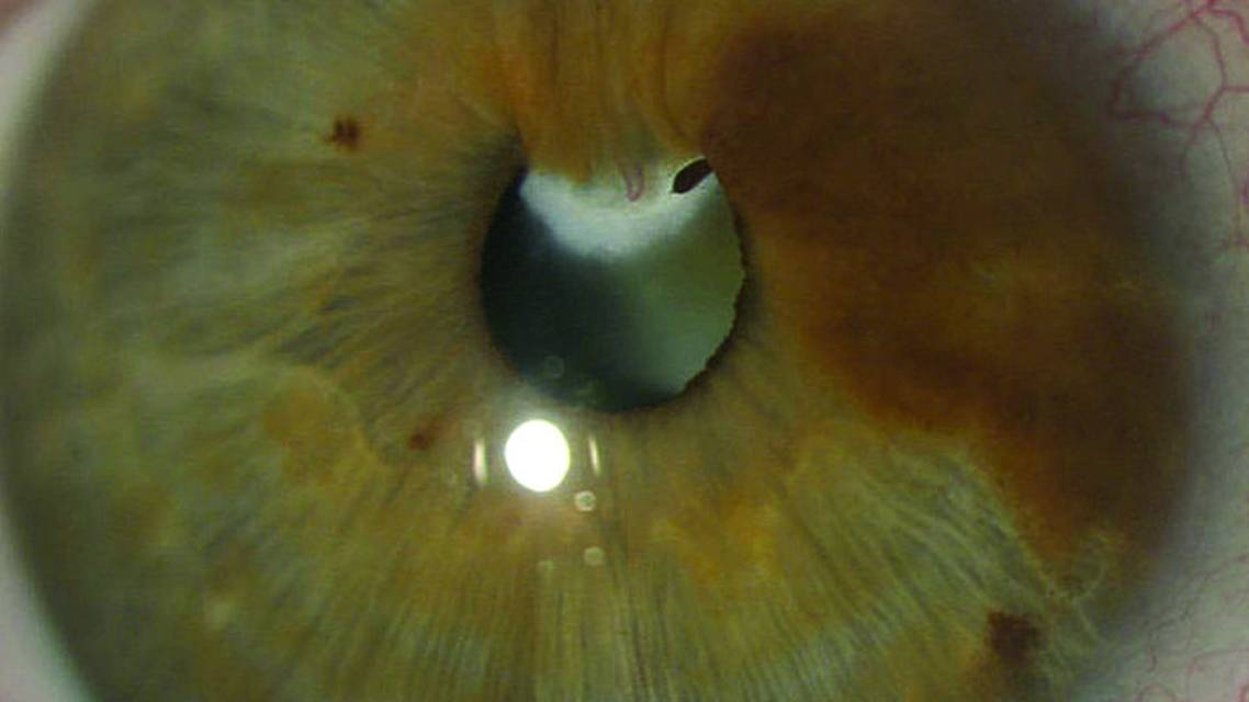 Congenital Cataract With Vascular Synechiae