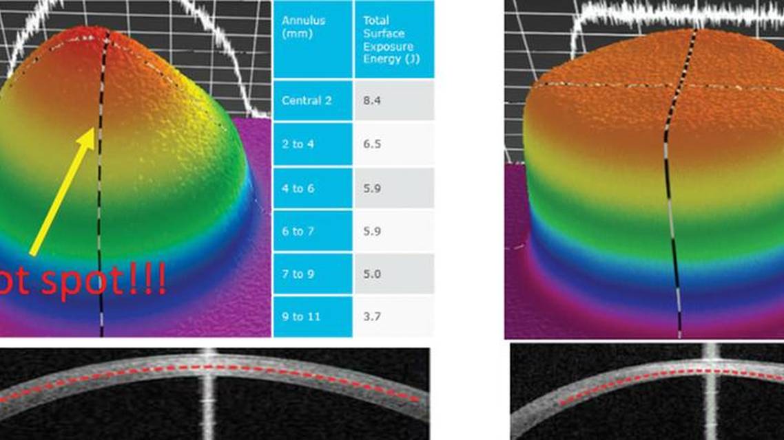 CXL Alone Versus in Combination With the STARE X Protocol