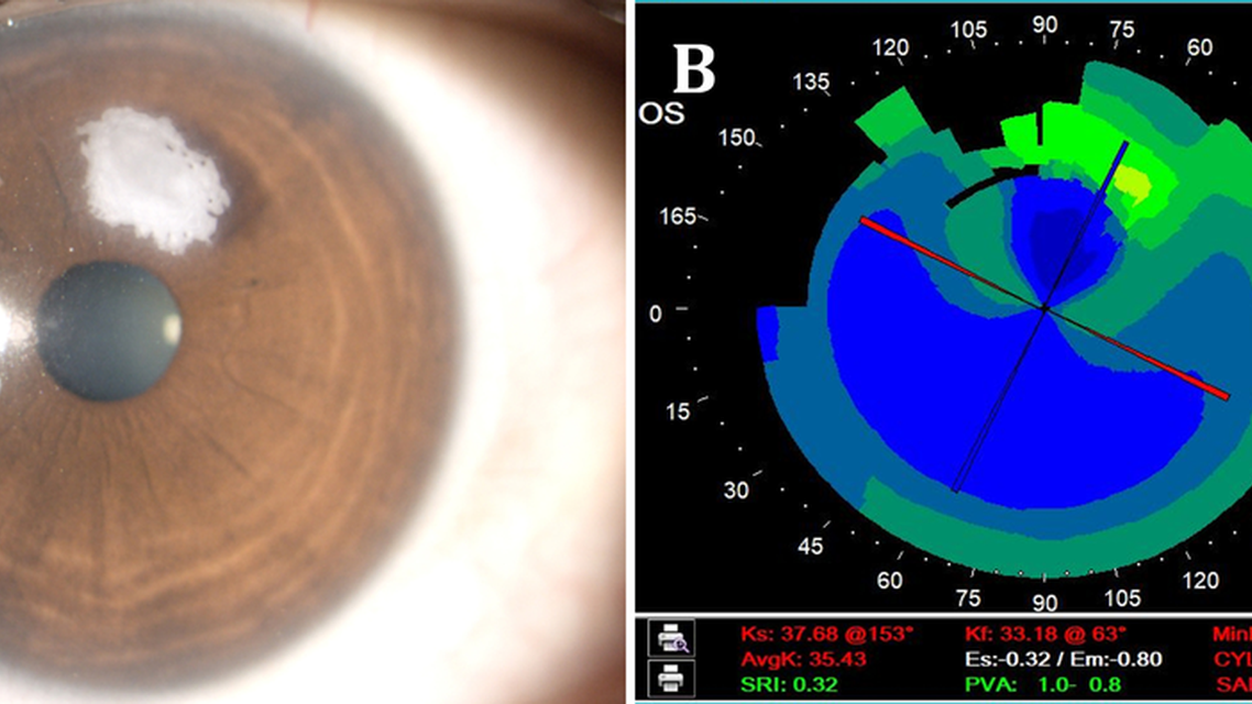 Epithelial Ingrowth After Laser Assisted Lenticule Extraction