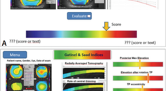 Detecting Early Keratoconus and Avoiding Iatrogenic Ectasia The SCORE Analyzer