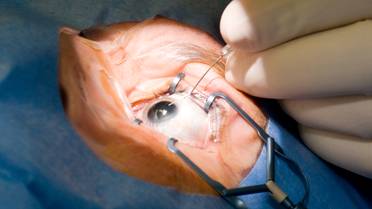Aetna Drops Prior Authorization for Most Cataract Surgeries image