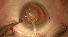 Zepto A viable Alternative to the Femtosecond Laser for FEMTIS IOL Implantation