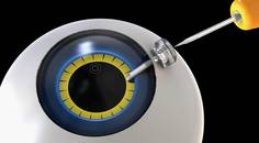 Maintaining Proper Anterior Chamber Pressure