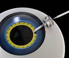 Maintaining Proper Anterior Chamber Pressure