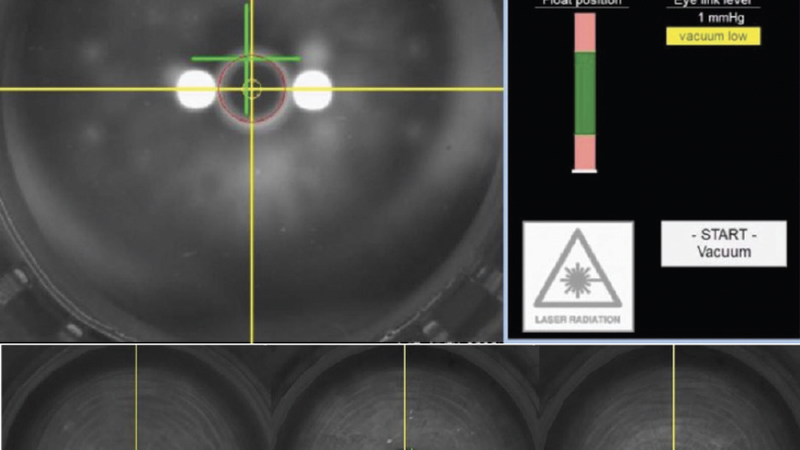 ATOS and SmartSight Current Trends and Procedural Volume
