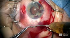 Yamane Technique and Iris Repair in Case of Trauma thumbnail