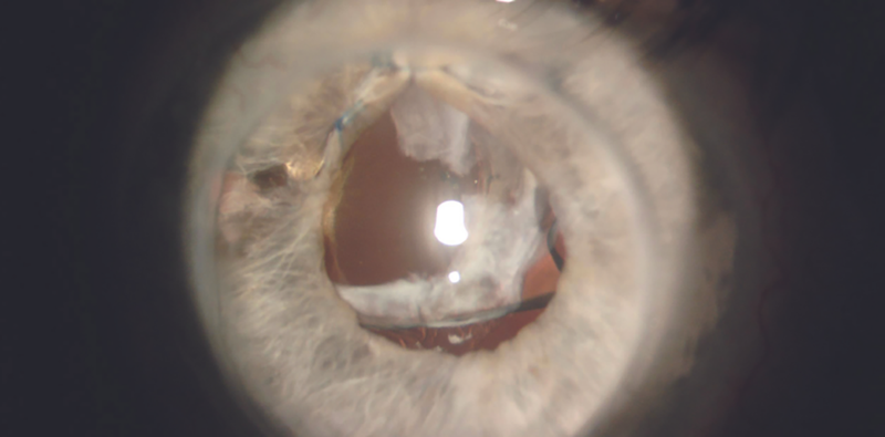 IOL Dislocation After Penetrating Keratoplasty