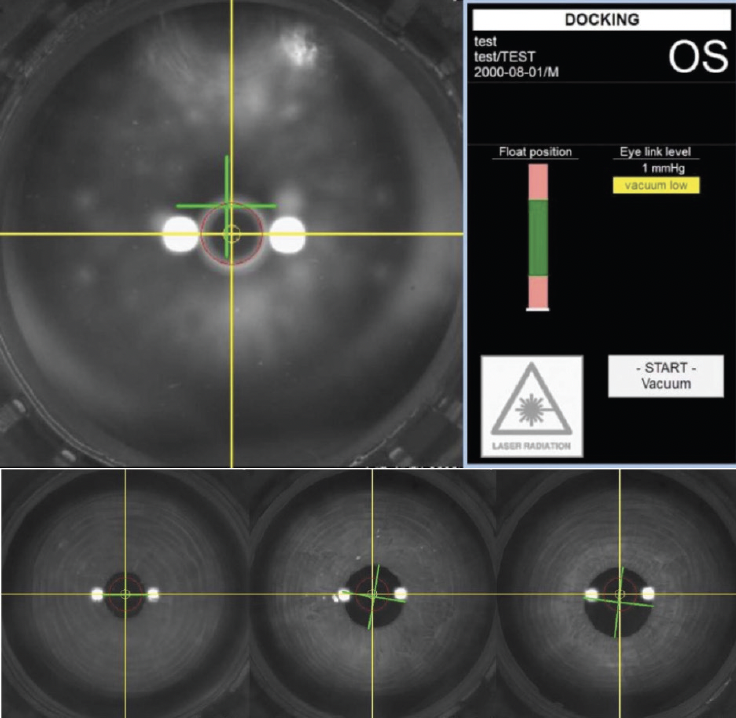 ATOS and SmartSight: Current Trends and Procedural Volume